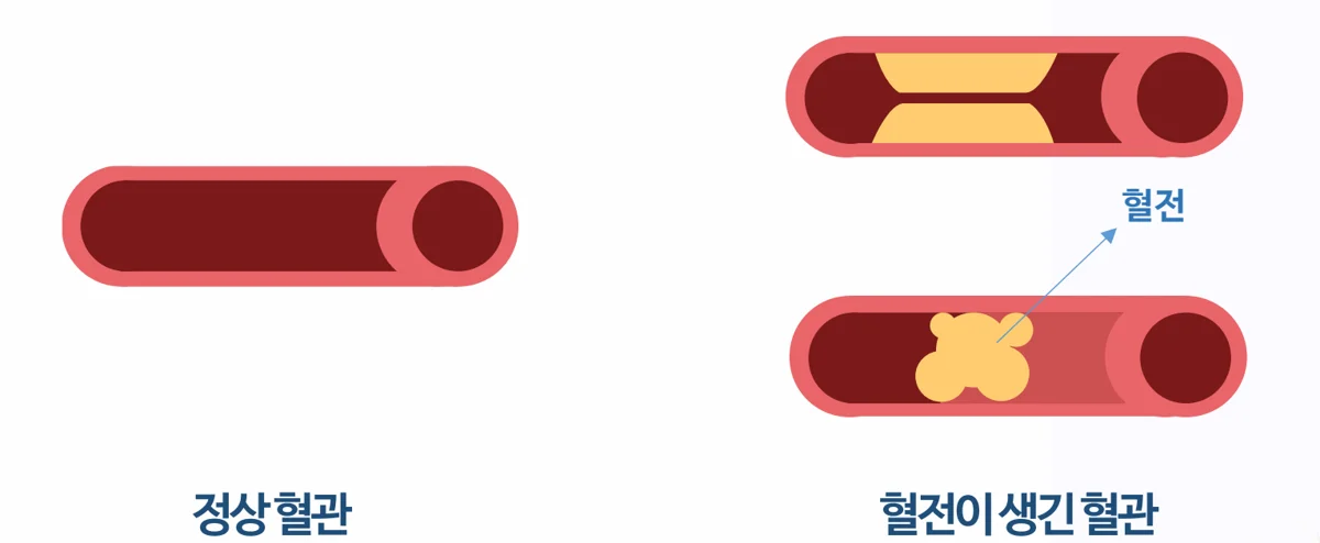 왼쪽은 깨끗한 정상 혈관, 오른쪽은 안쪽에 혈전이 생겨 좁아지거나 막힌 혈관